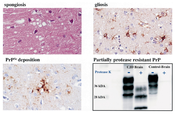 국내 CJD 환자의 신경병리학적/면역세포학적 분석 및 병원성 프리온 단백질 검출